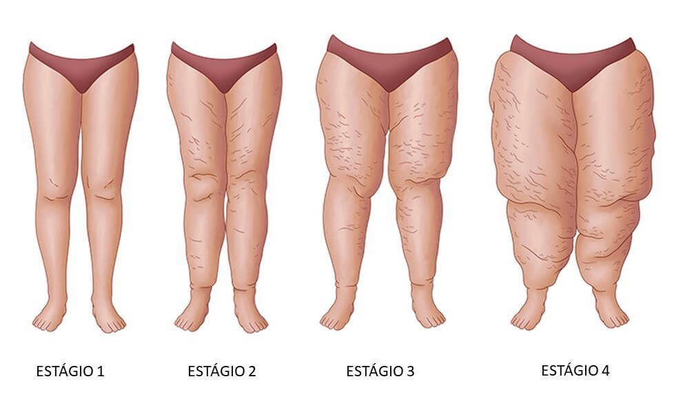 Ilustração dos 4 estágios do Lipedema