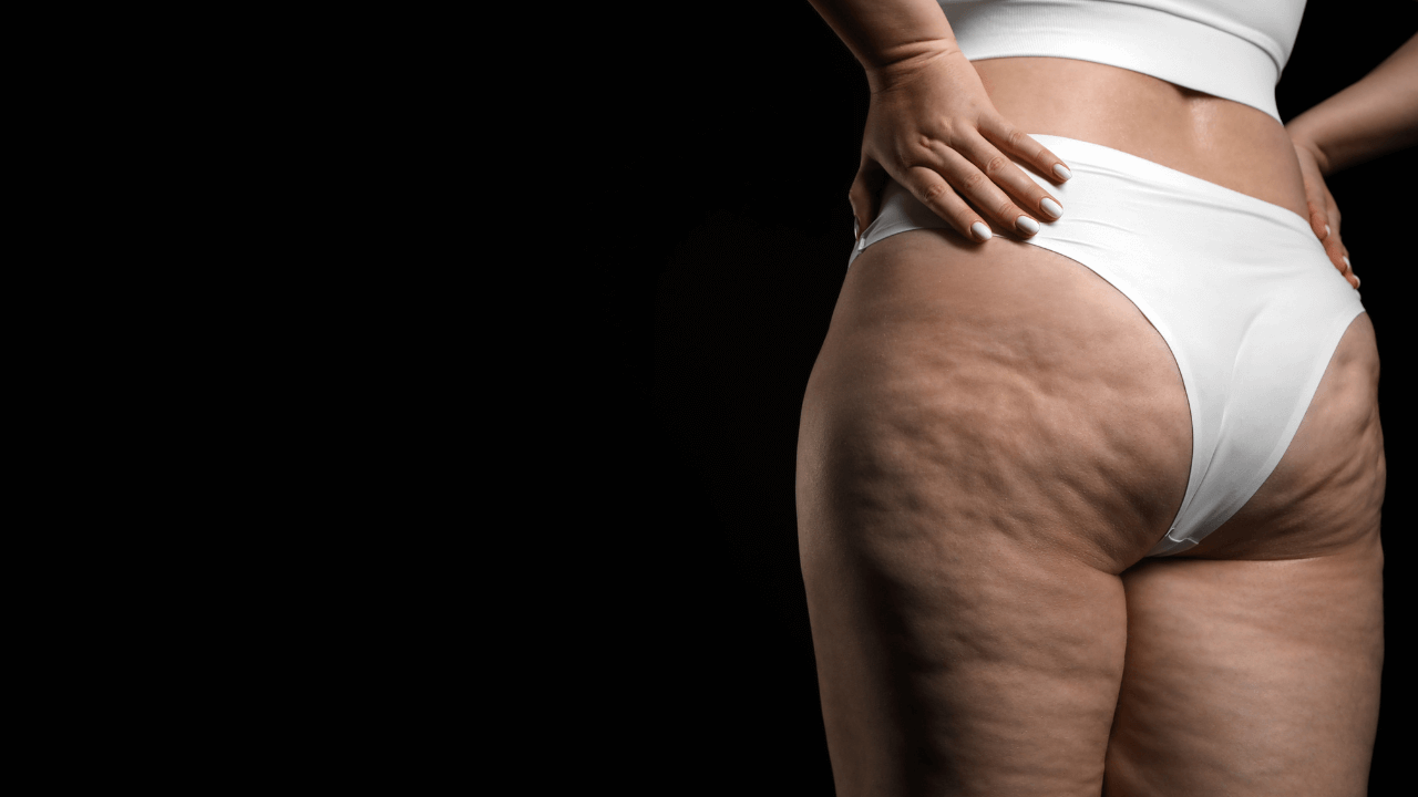 Visual da pele com Lipedema e Celulite
